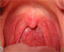 kataralnaya-angina-simptomy-lechenie